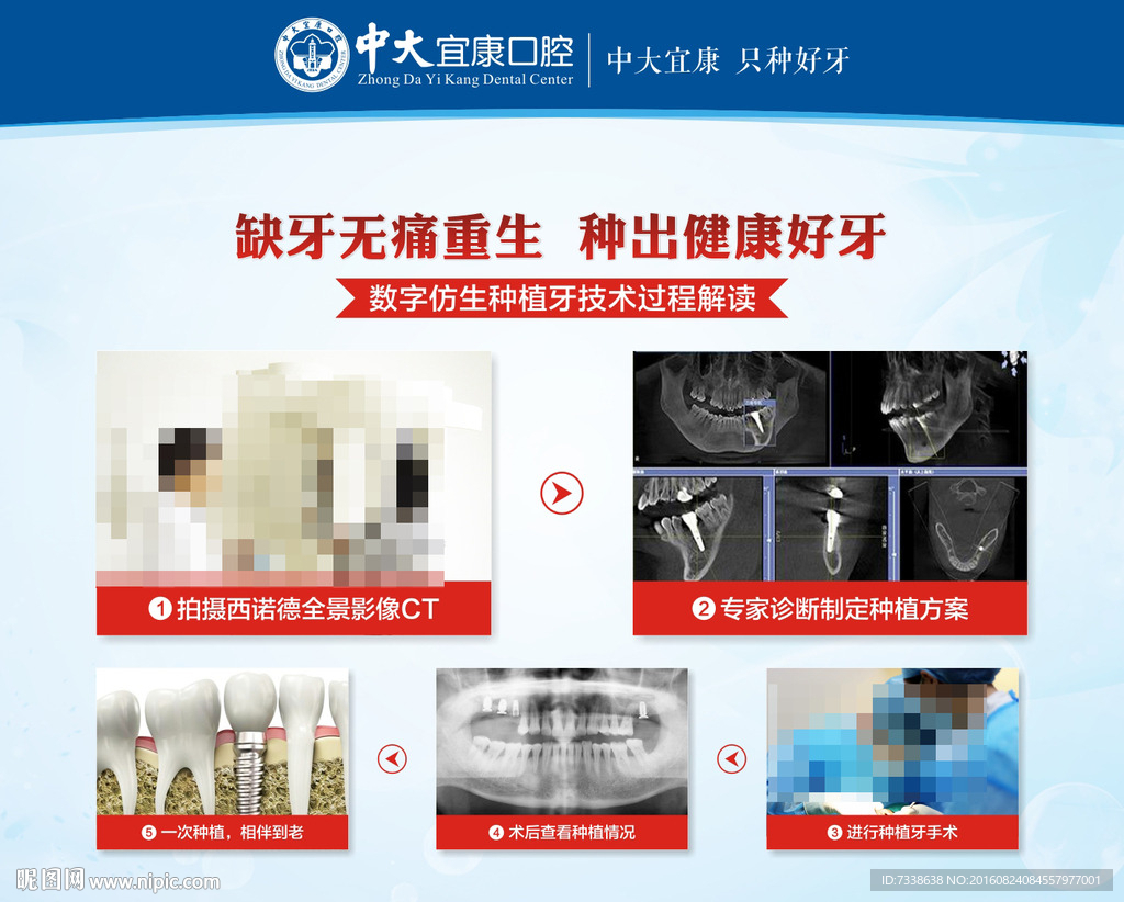 数字仿生种植牙技术过程