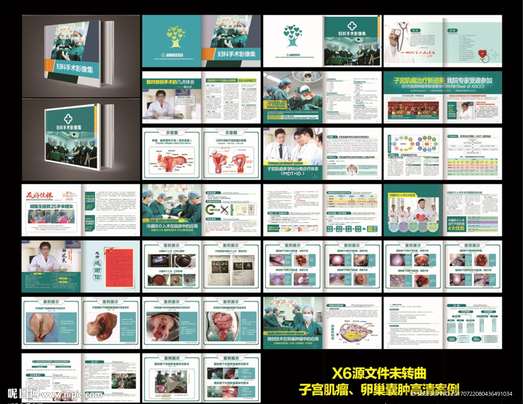 子宫肌瘤 医疗画册