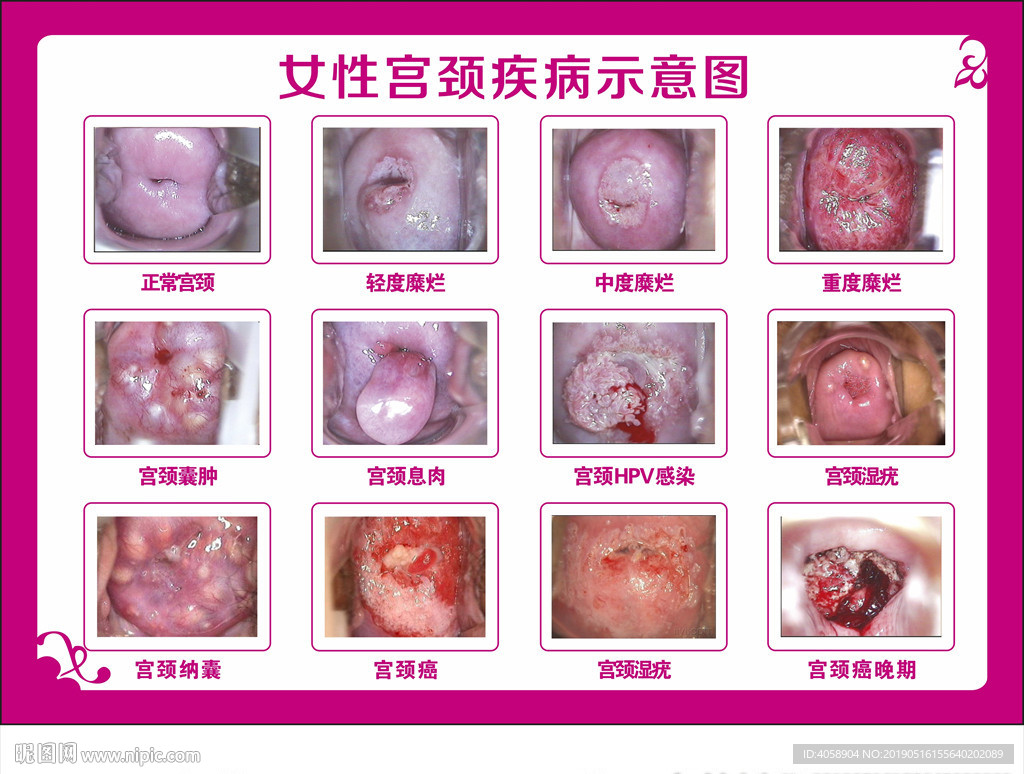 女性宫颈疾病示意图