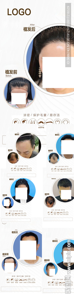 植发案例