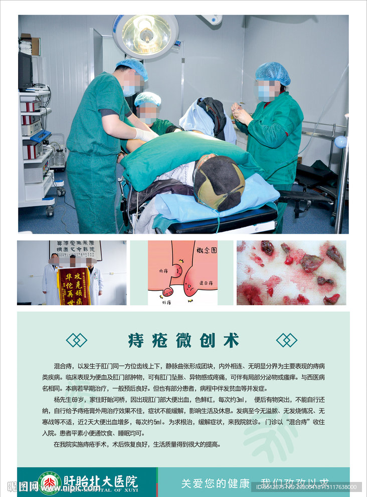 痔疮案例