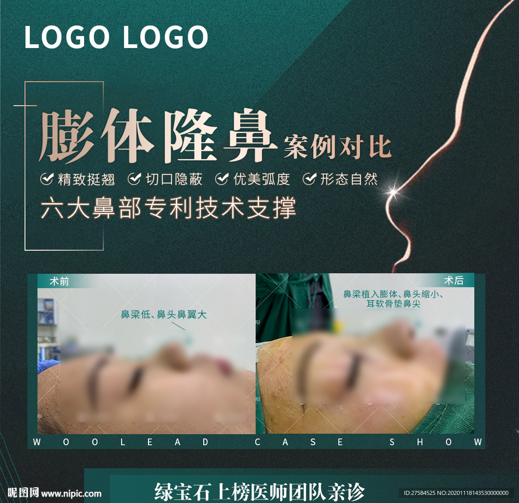 膨体隆鼻案例对比