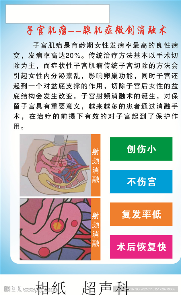 子宫肌瘤  腺肌症微创消融术
