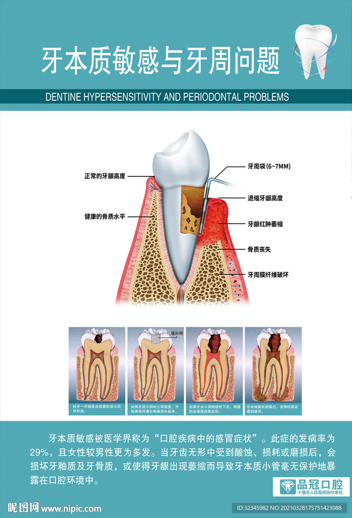 口腔医院挂图——牙本质敏感问题