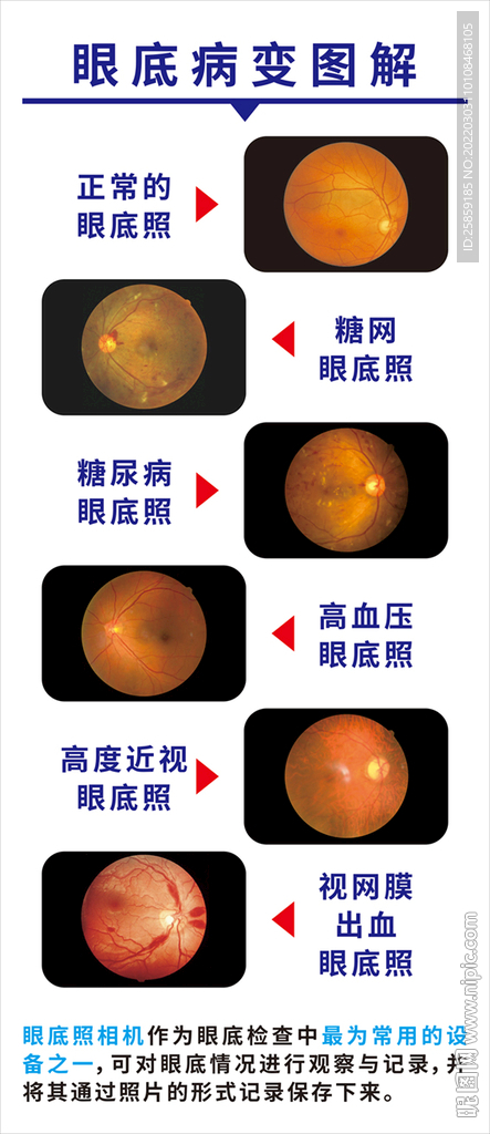 眼底病变图解