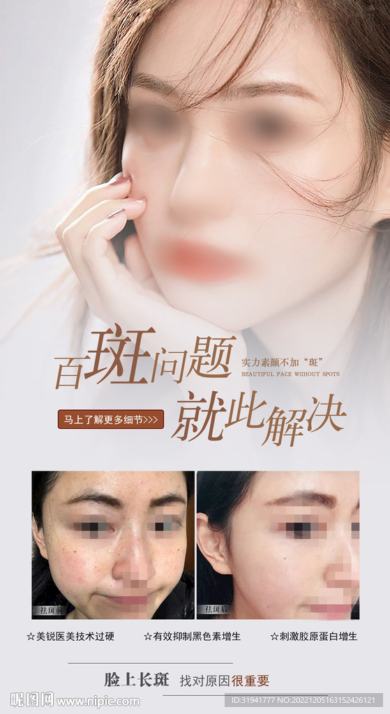 祛斑