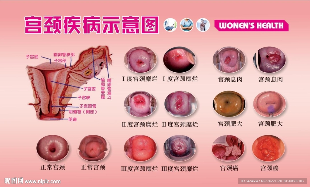 妇科宫颈疾病示意图