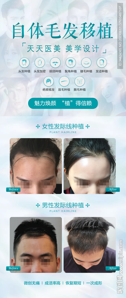 植发