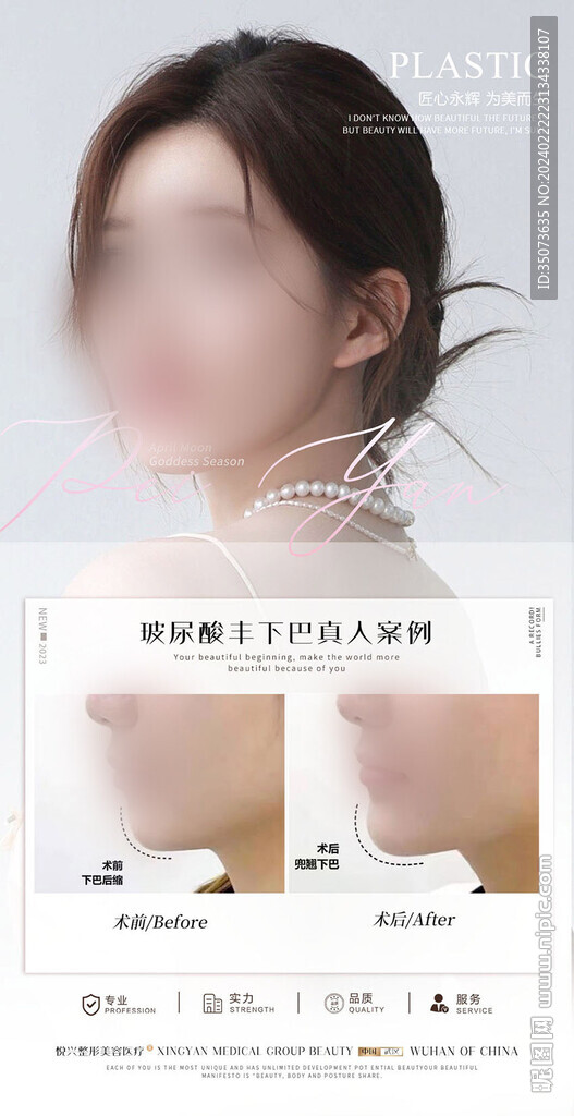 玻尿酸丰下巴案例