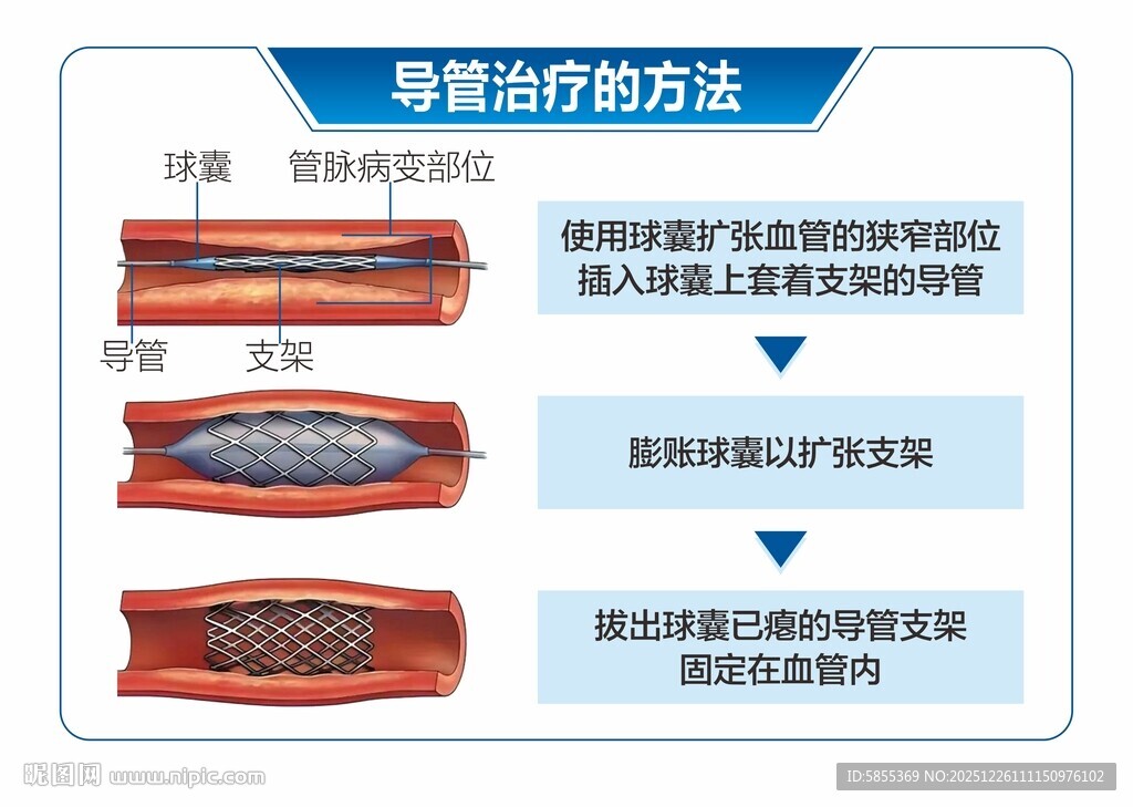 动脉硬化闭赛症导管治疗