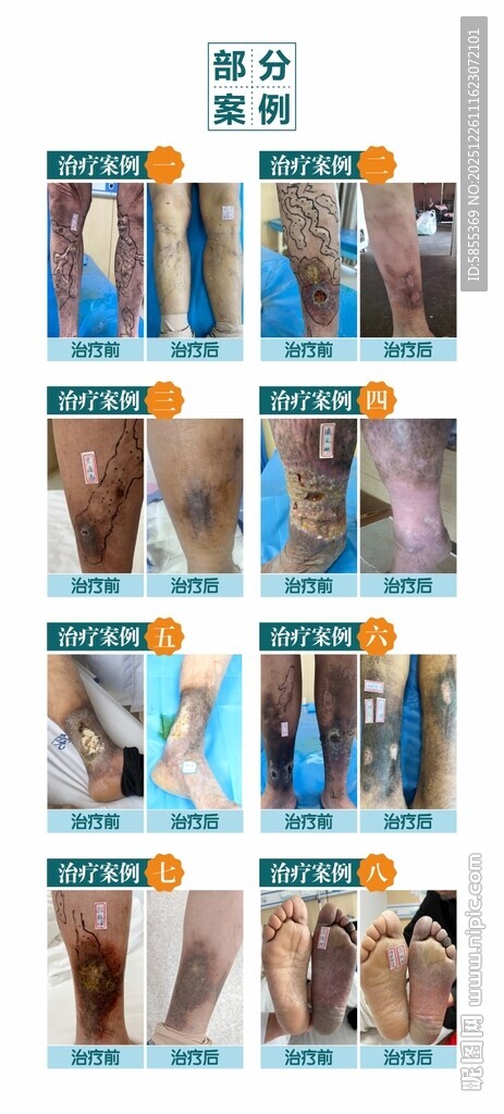 静脉曲张案例图