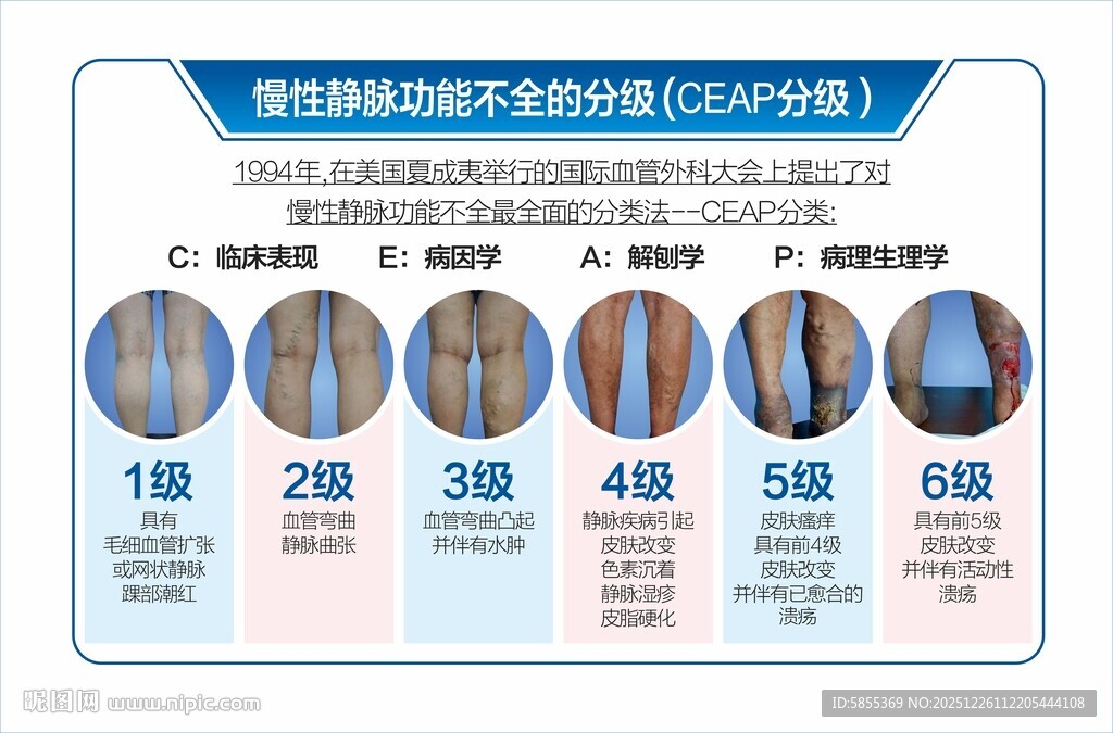 静脉曲张分期图