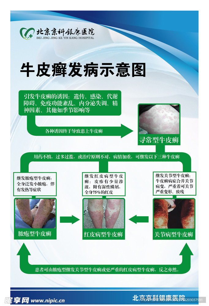 牛皮癣发病示意图