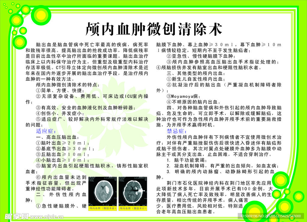 颅内血肿微创清除术