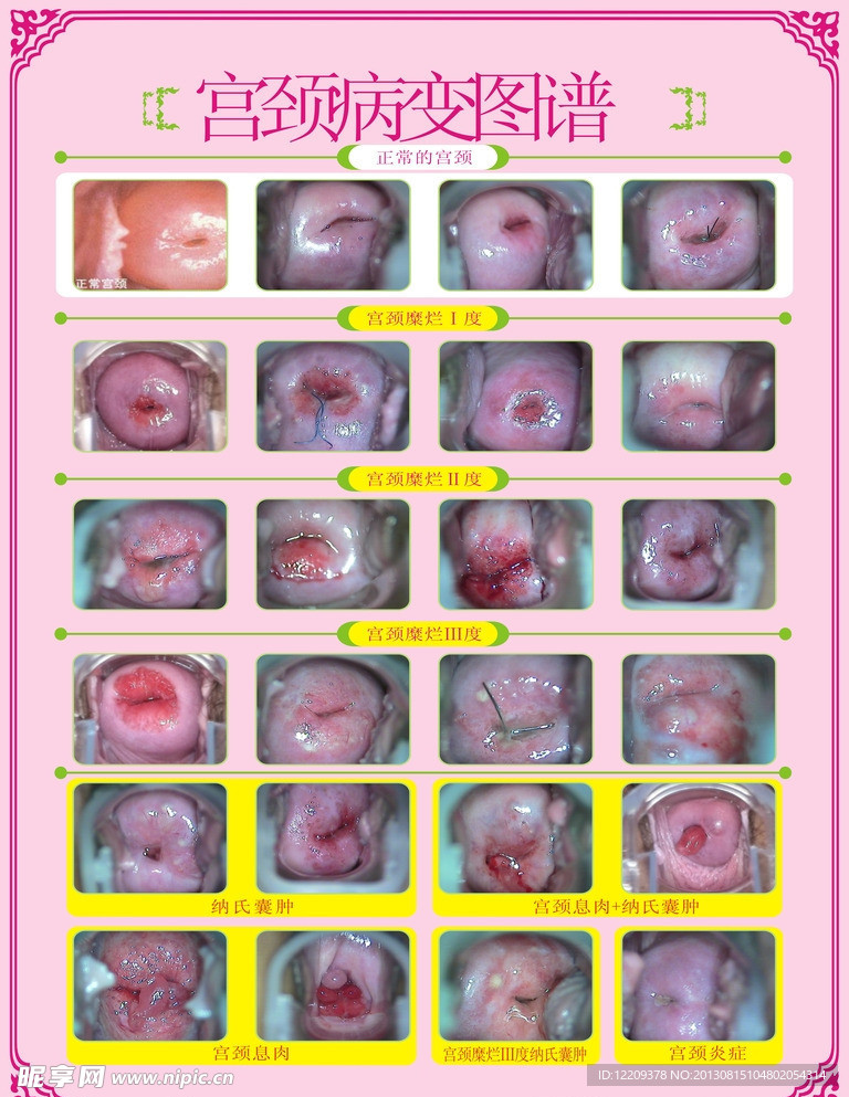 宫颈病变图谱