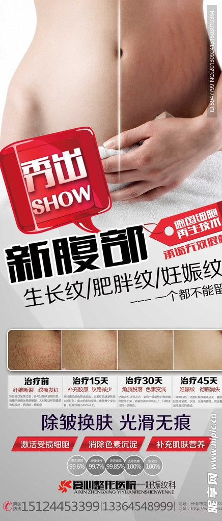 整形妊娠纹 展架