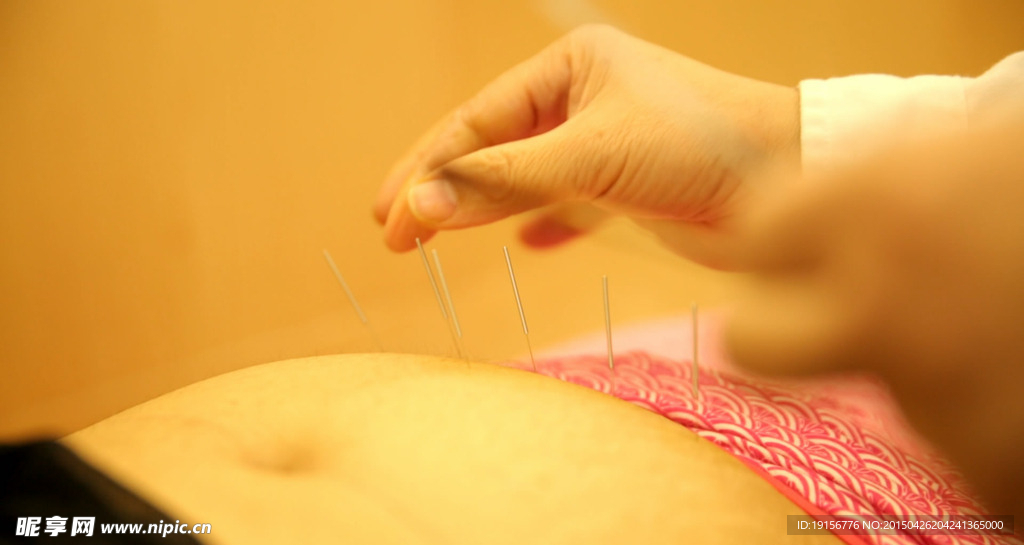 针灸中医治疗实拍素材