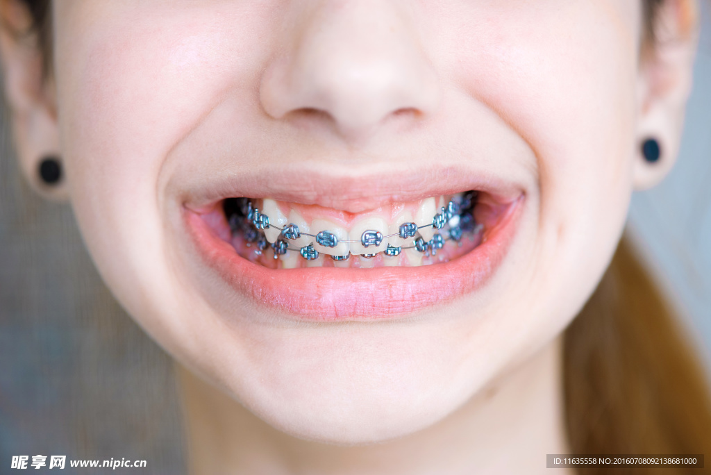 带牙套的美女