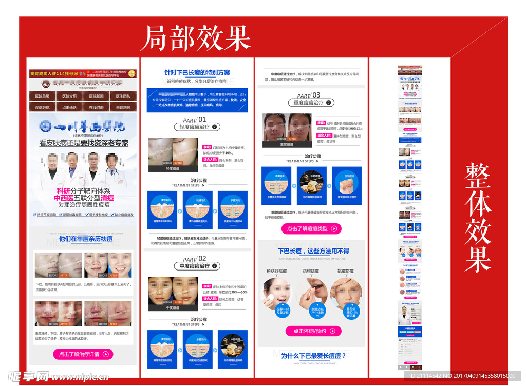 青春痘专题图片 顽固性痘痘专题