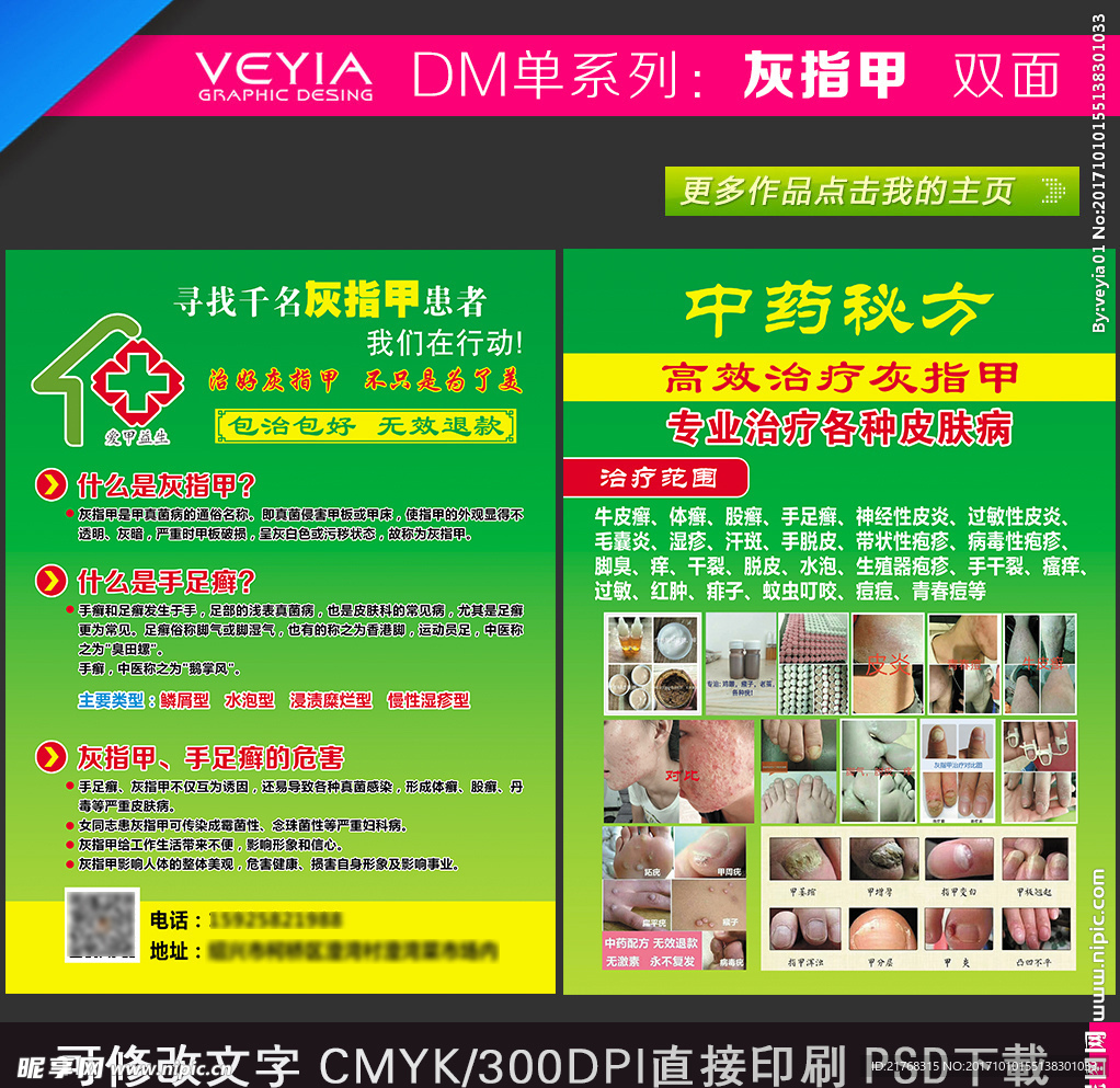 灰指甲 灰指甲宣传单 中药秘方