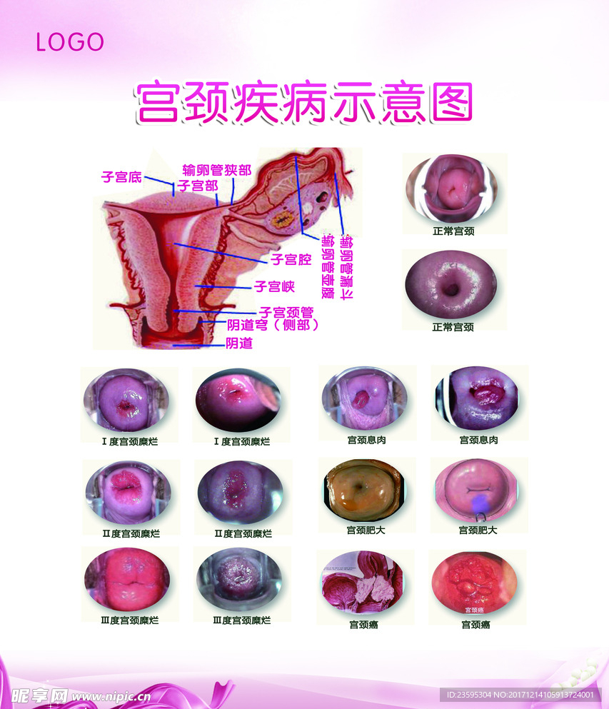 宫颈疾病示意图