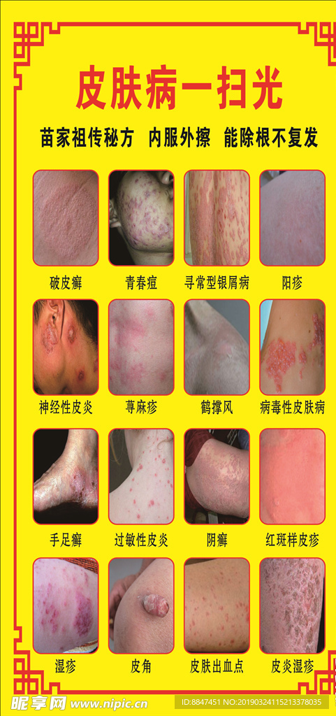 皮肤病  青春痘  海报 展板