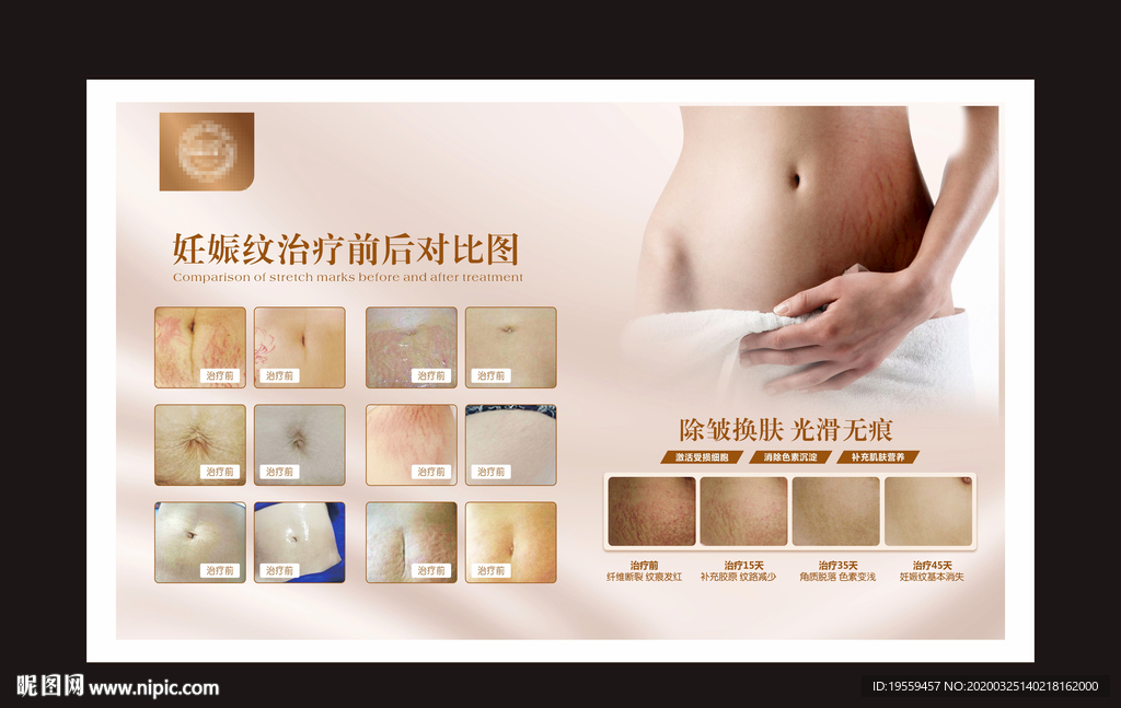妊娠纹对比图