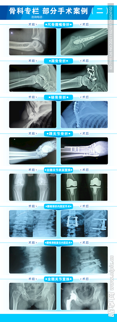 骨科手术案例展示