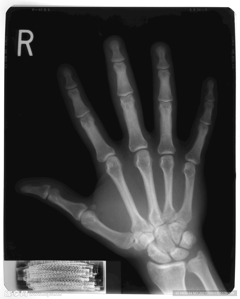 手掌X光片
