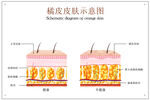 橘皮皮肤示意图