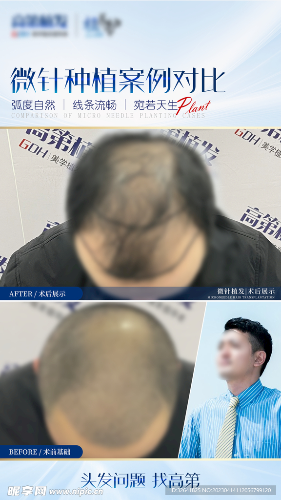 植发案例图