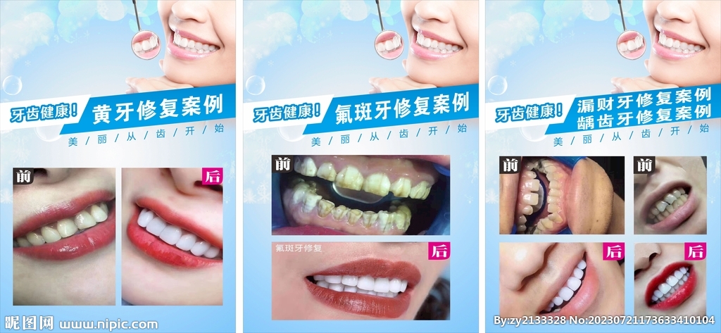 牙齿修复案例