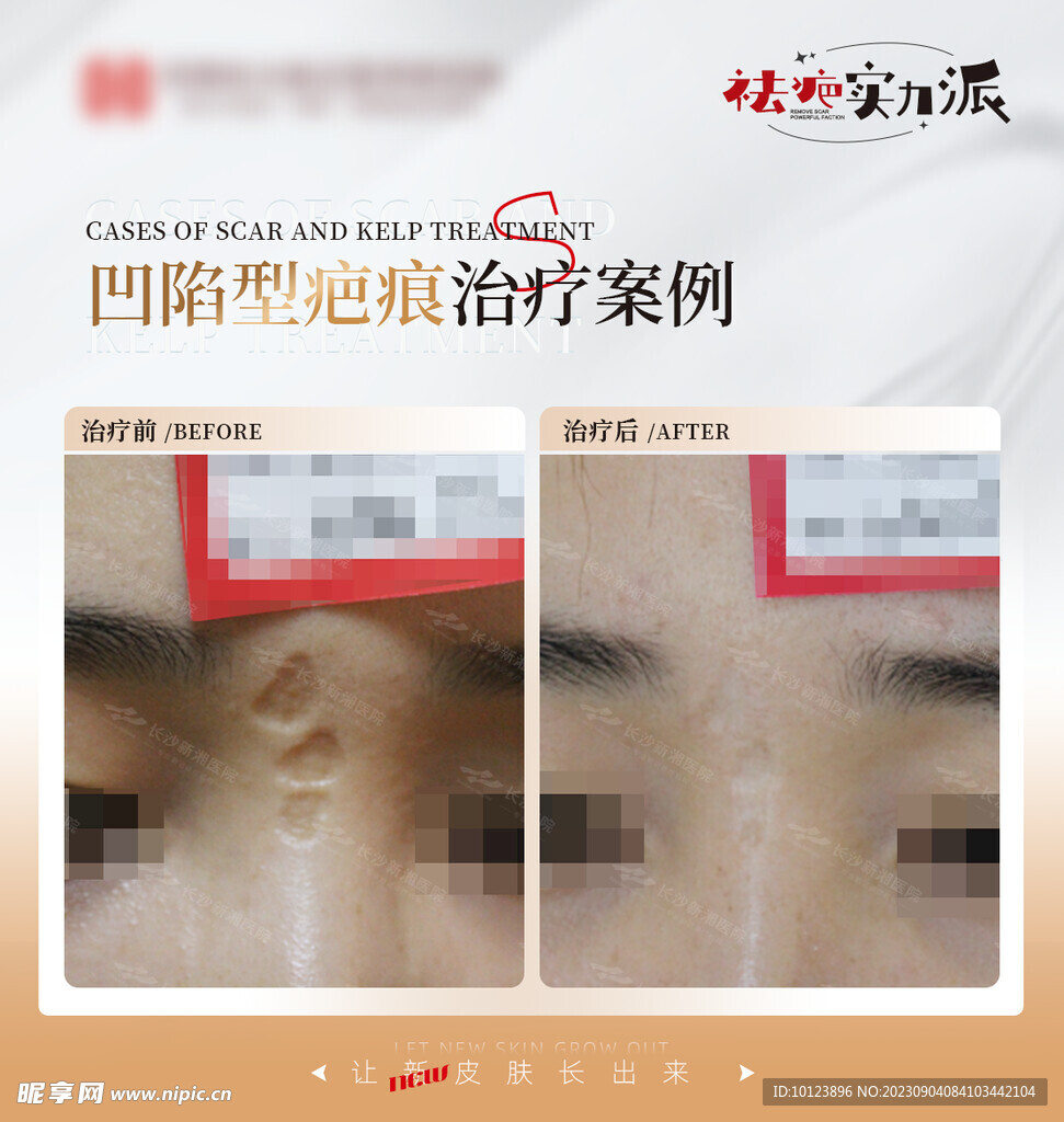 治疗案例对比图