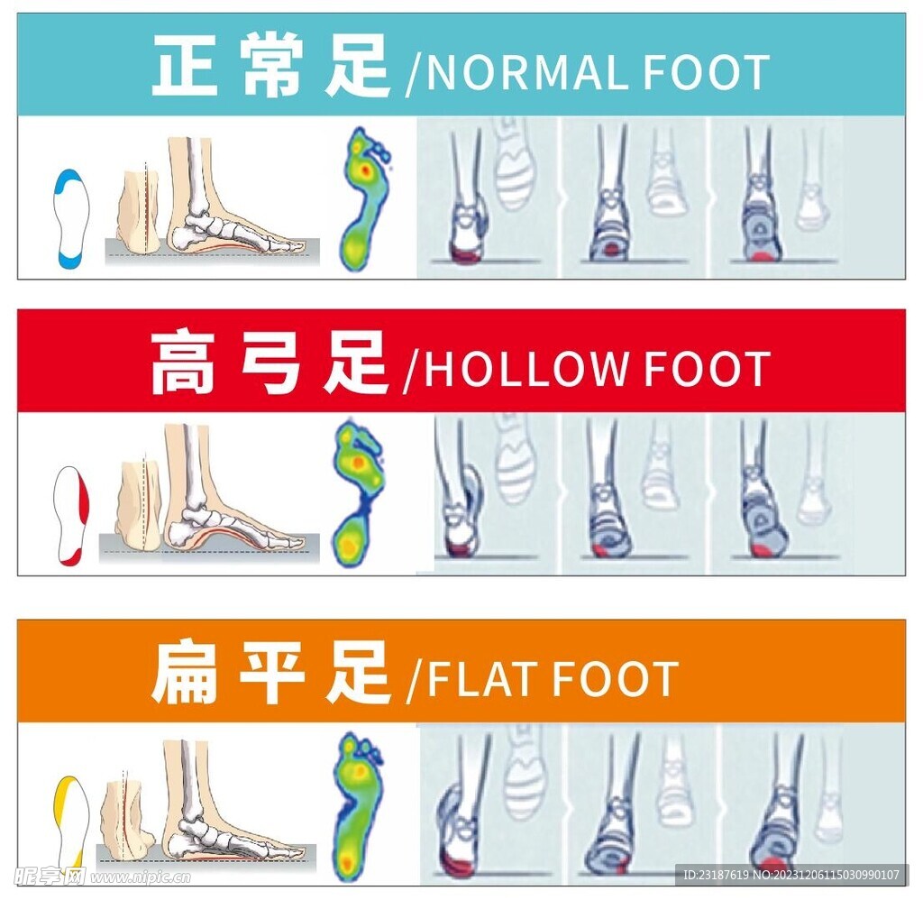 正常足扁平足高弓足
