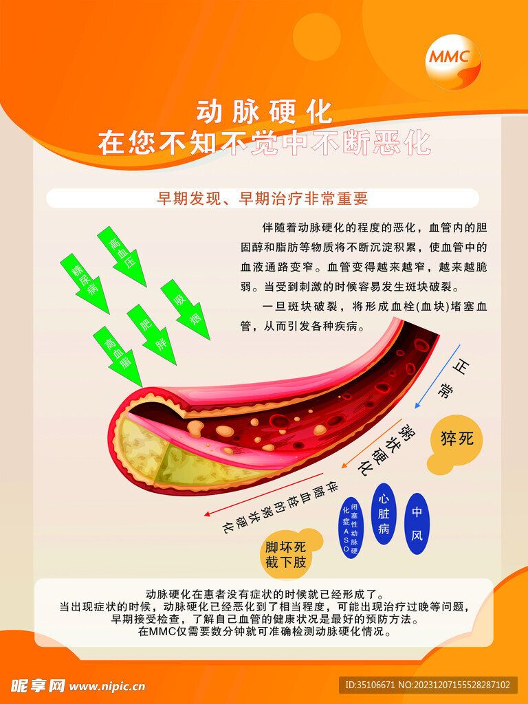 MMC制度牌动脉硬化