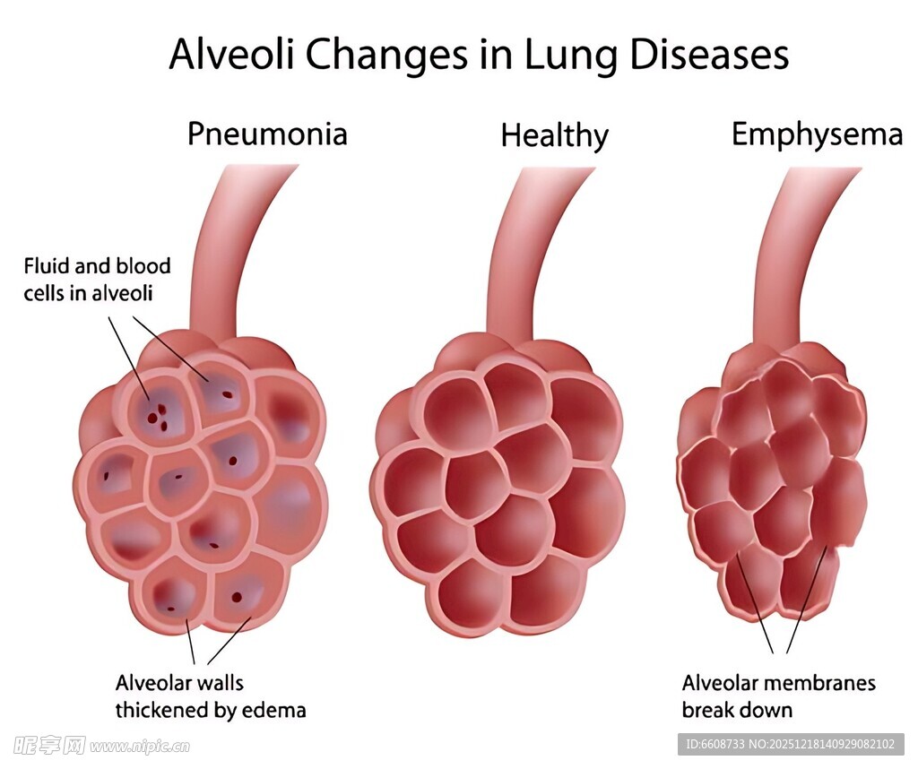 肺部疾病中肺泡的变化