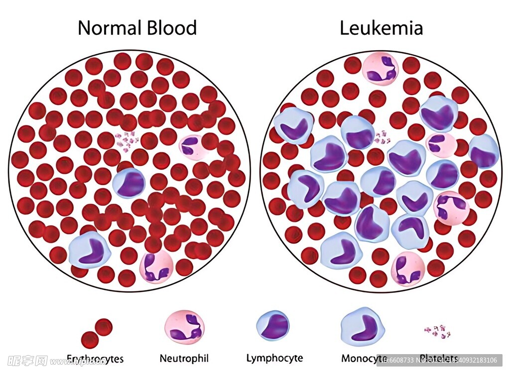 正常与白血病血液细胞对比
