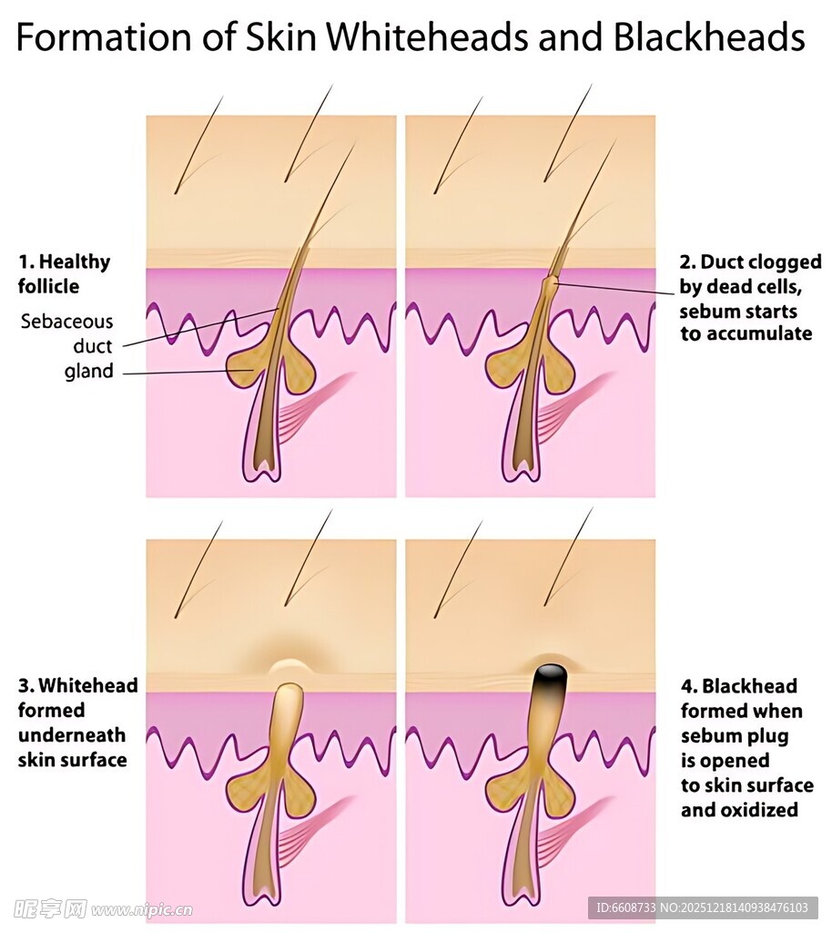 白头黑头形成过程图示