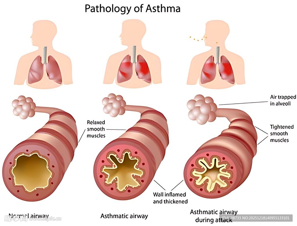 哮喘病理图示