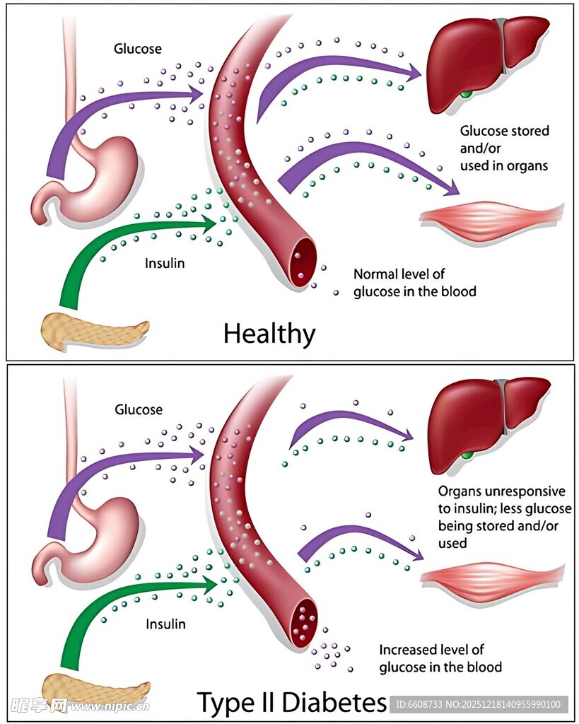 健康与2型糖尿病肝脏对比