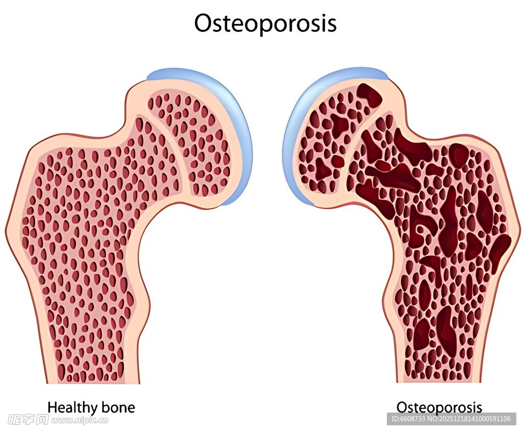 健康与骨质疏松骨骼对比