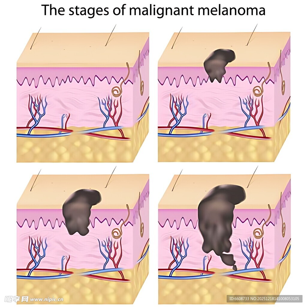 黑色素瘤的不同发展阶段