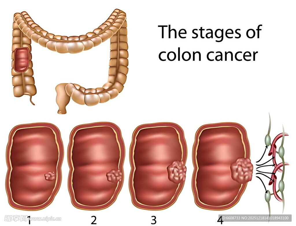 结肠癌的发展阶段图示