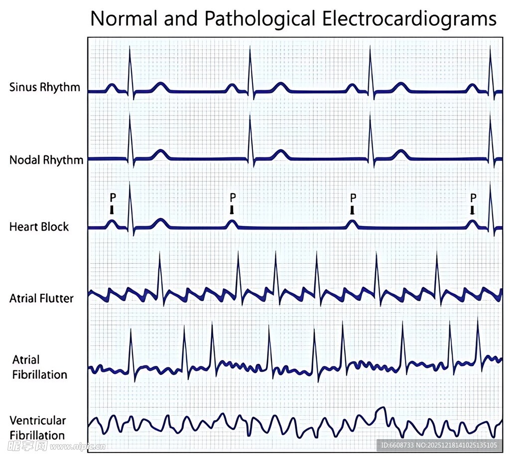 正常与病理心电图对比