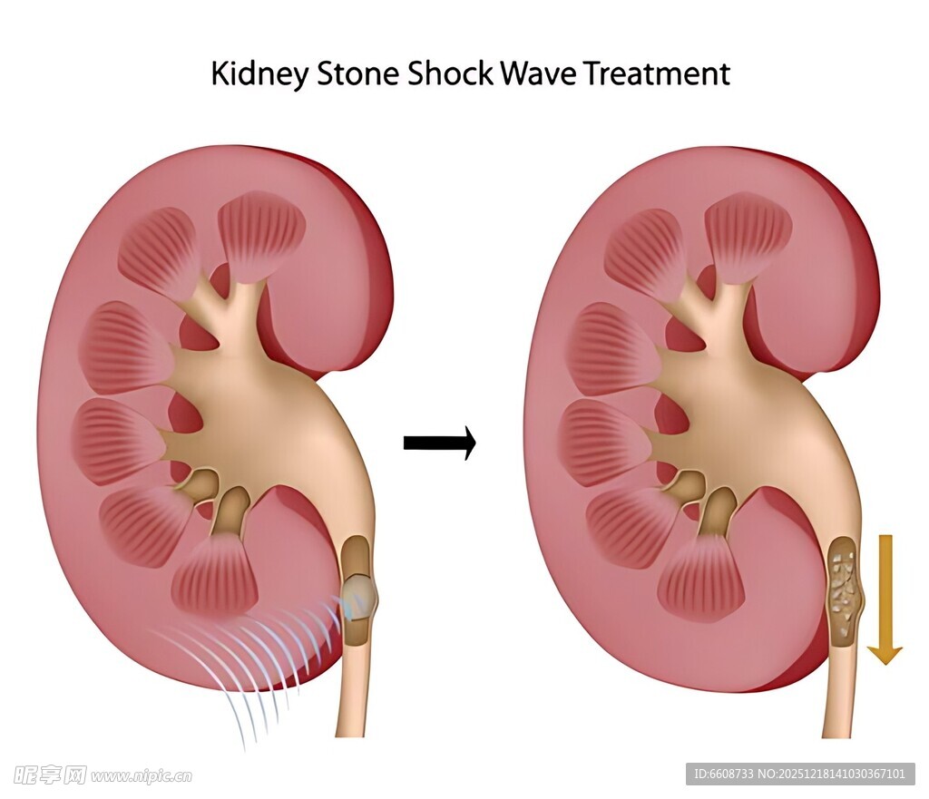 肾脏休克治疗图示