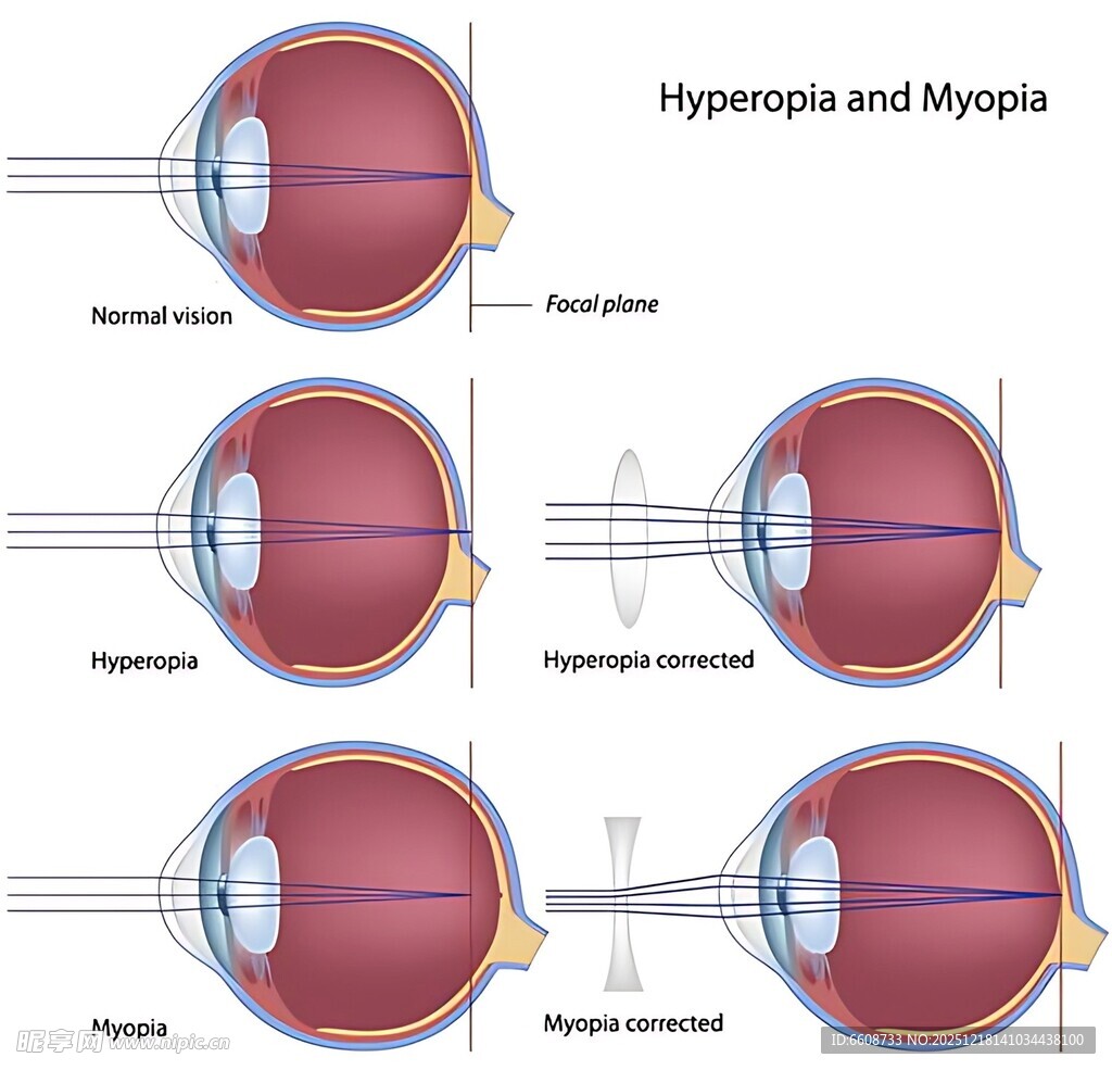 眼睛屈光不正示意图