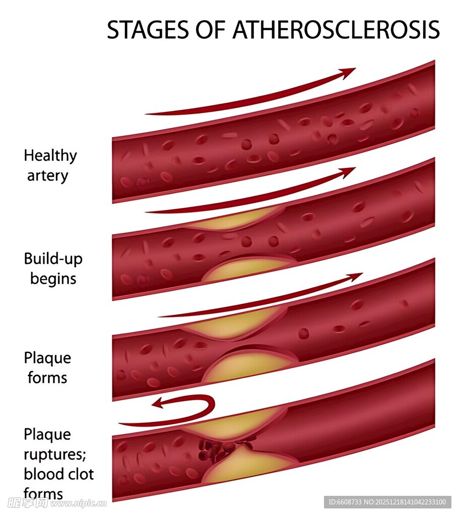 动脉粥样硬化的不同阶段