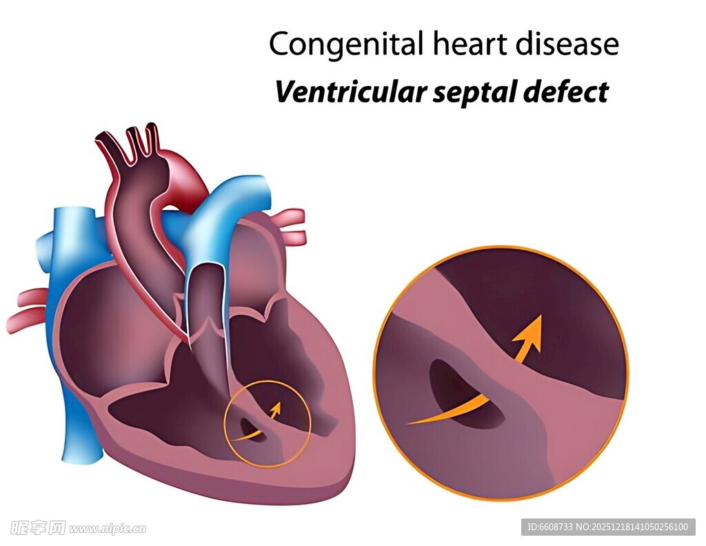 先天性心脏病之室间隔缺损