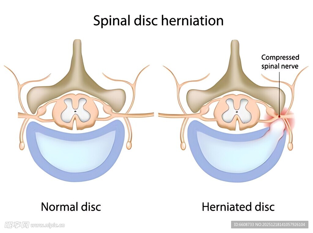 椎间盘突出示意图