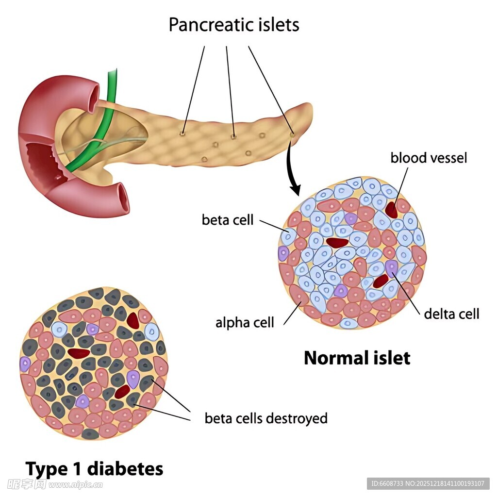 胰腺胰岛与1型糖尿病图示